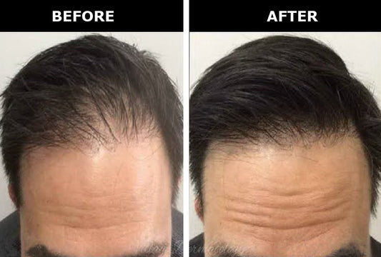 Adivasi Hair Growth Oil (500ML 3 Month Half Course)